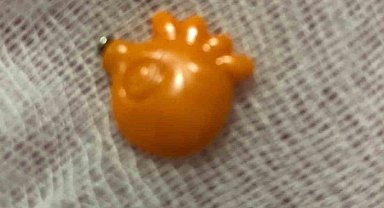 Elazığ'da 9 aylık bebeğin boğazına kaçan yabancı cisim başarıyla çıkartıldı