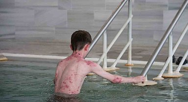 Tedavisi mümkün olmayan hastalığa bu su şifa oldu